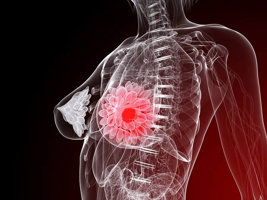 Testări gratuite pentru depistarea cancerului de sân la Iacobeni