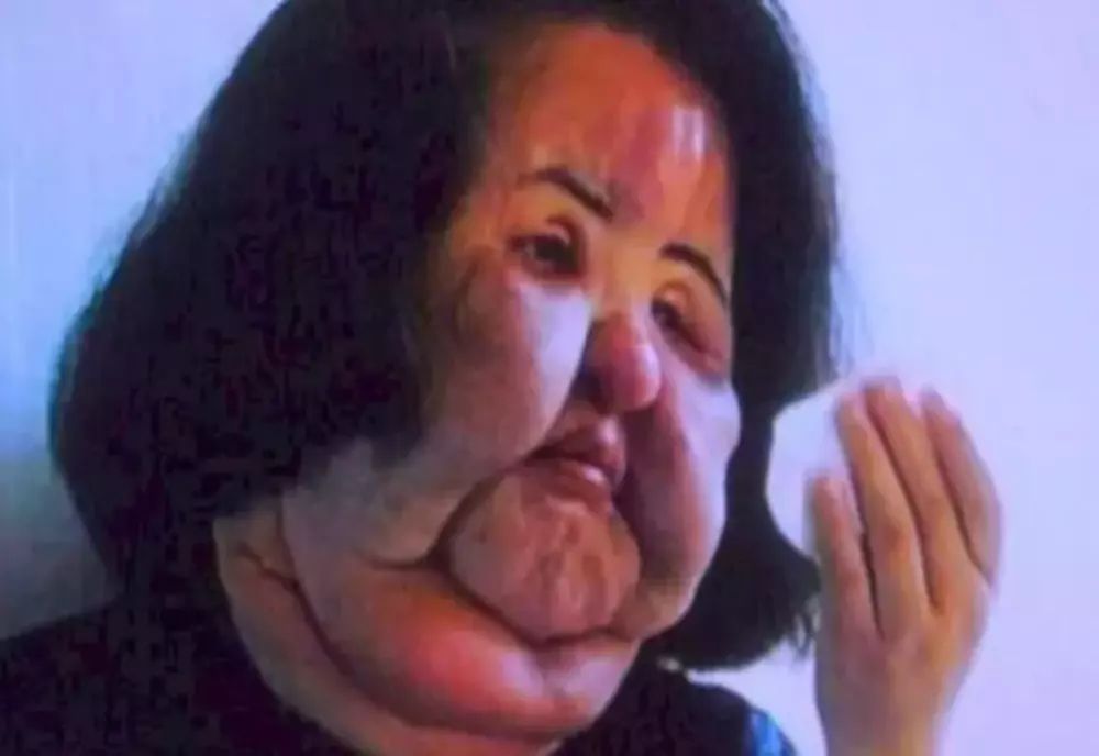 Povestea terifiantă a femeii care şi-a injectat ulei pentru gătit în faţă. Motivul a şocat!