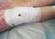 FOTO/ Fetiță de 10 ani sfâșiată de un câine fără stăpân